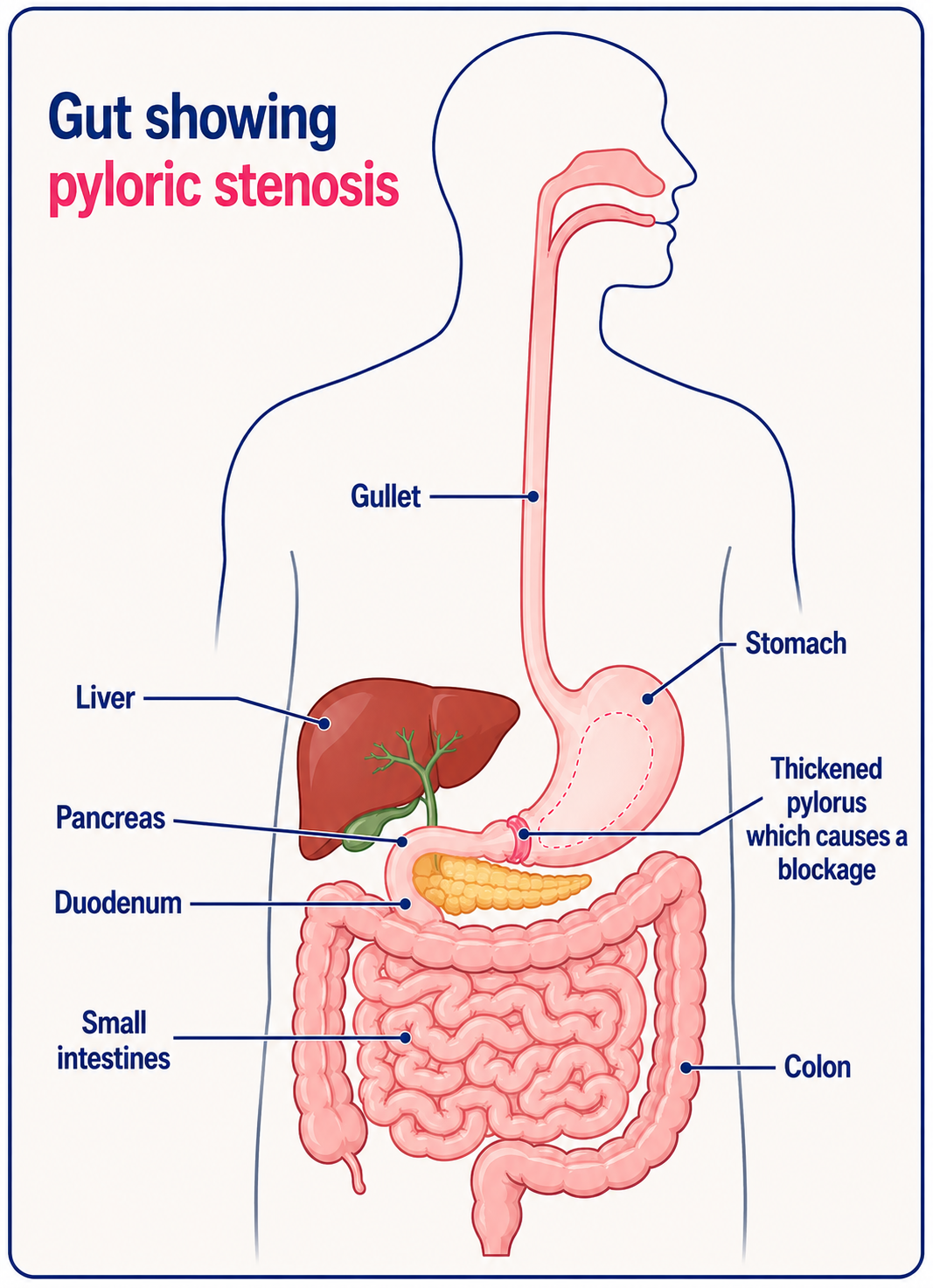 pyloric stenosis