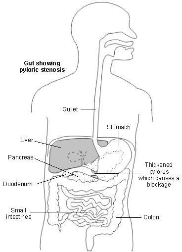 pyloric stenosis