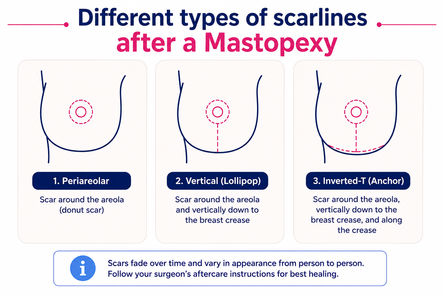 Mastopexy scarlines