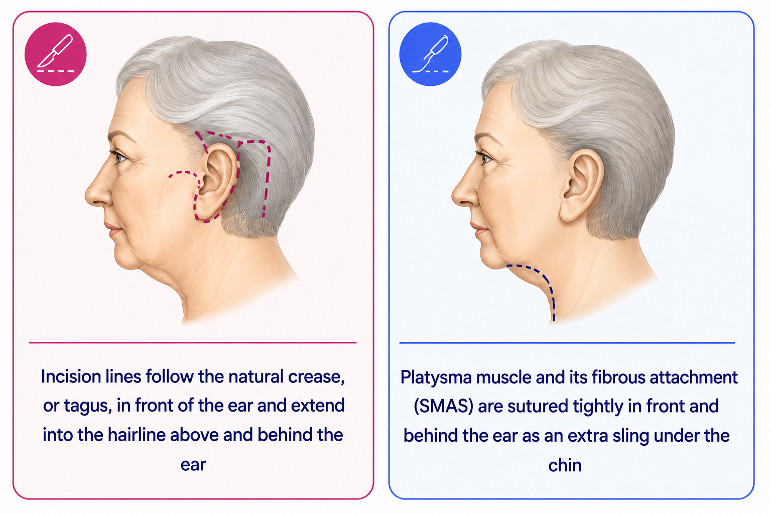 Facelift