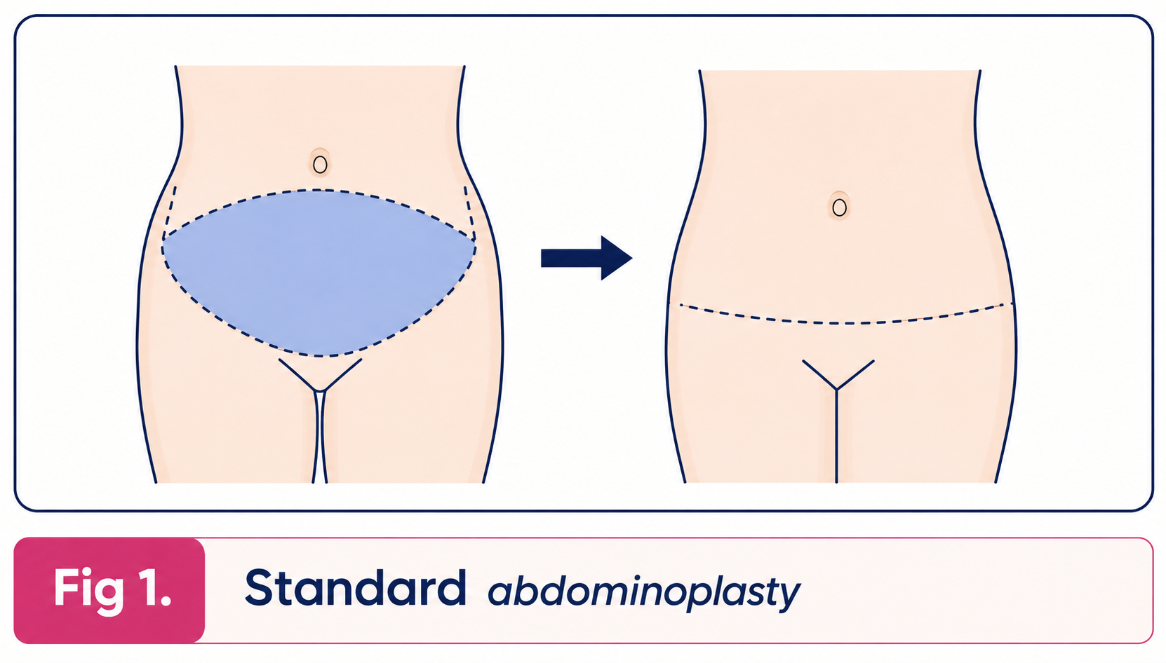 Standard abdominoplasty