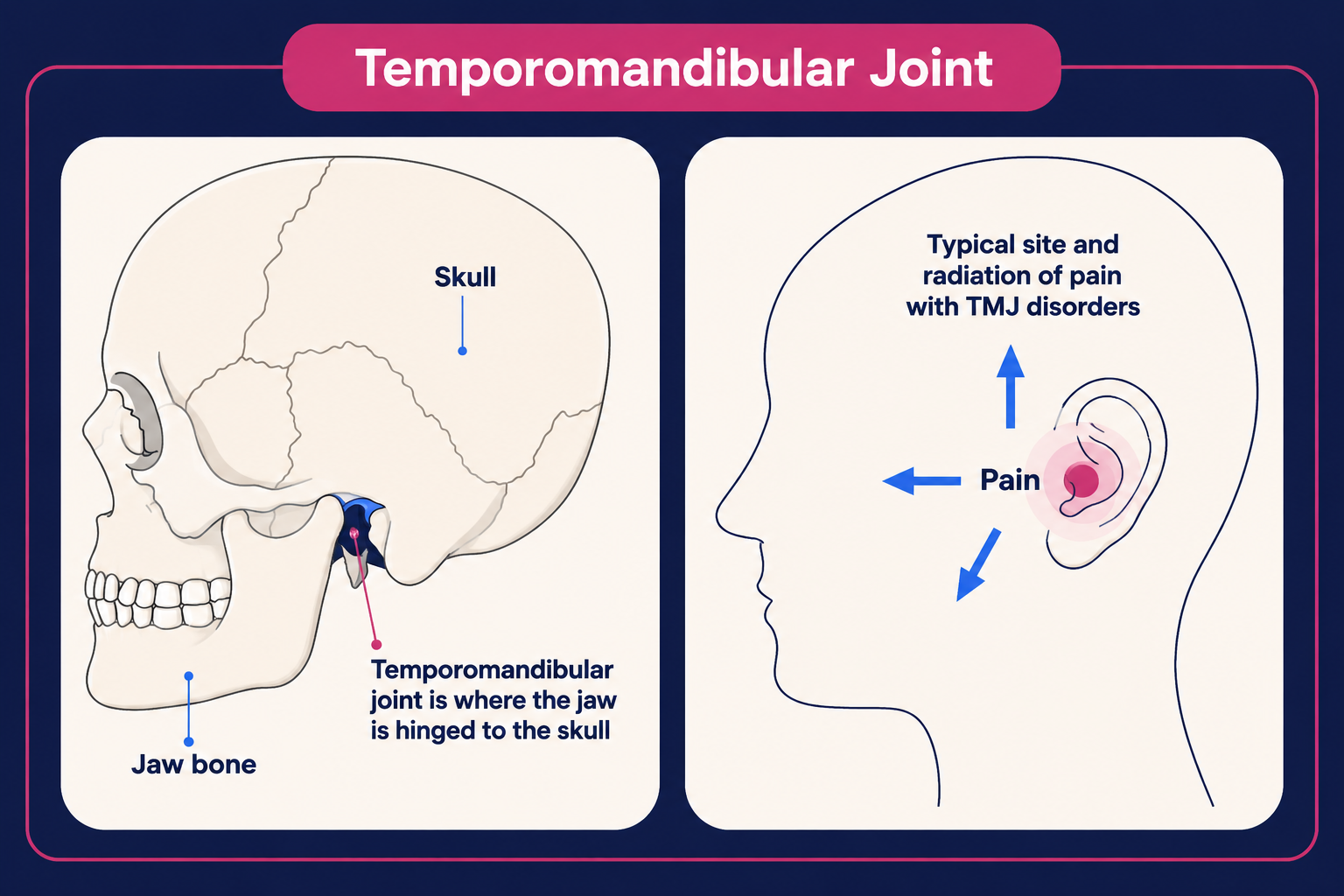 TMJ dysfunction