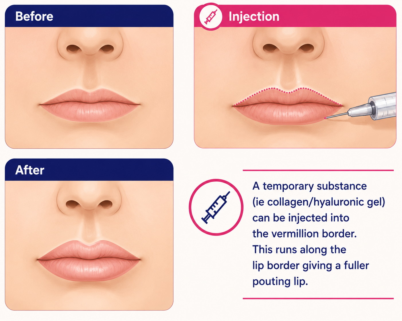 Lip enhancement