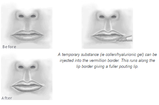 Lip enhancement