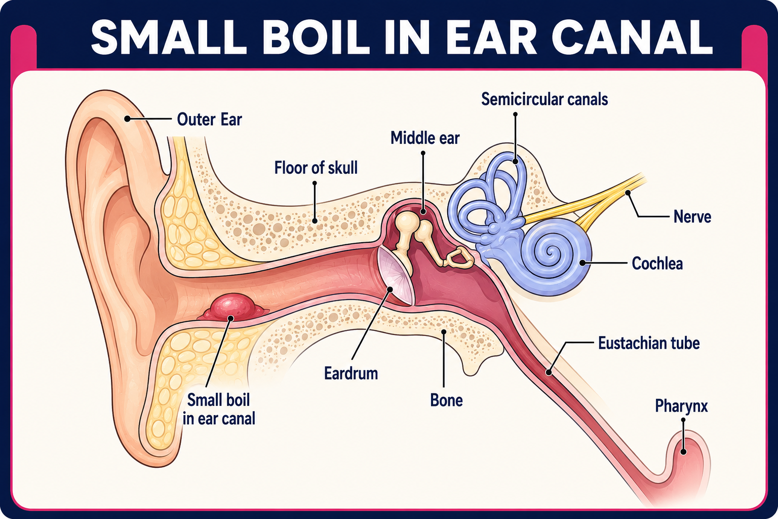 Boil in the ear canal (Beverley Kenny)