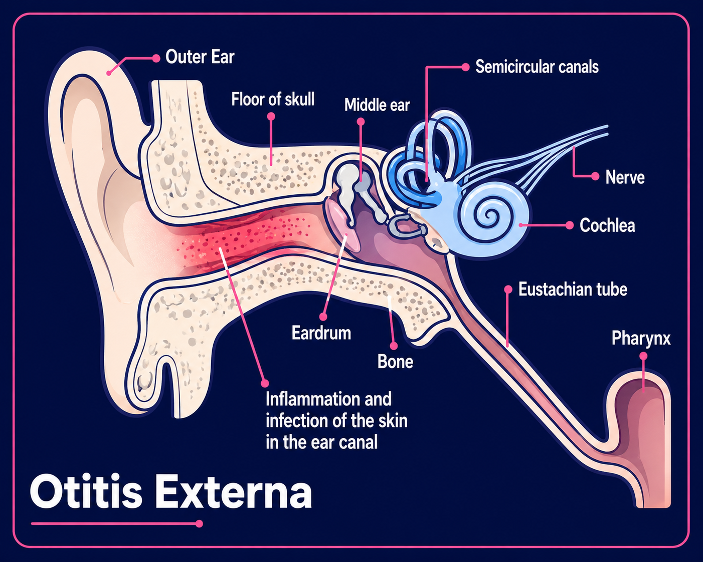 The ear - otitis externa