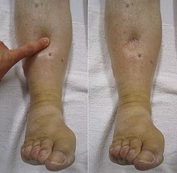 Peripheral oedema