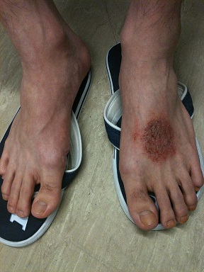 Lichen simplex on dorsum of foot of young man