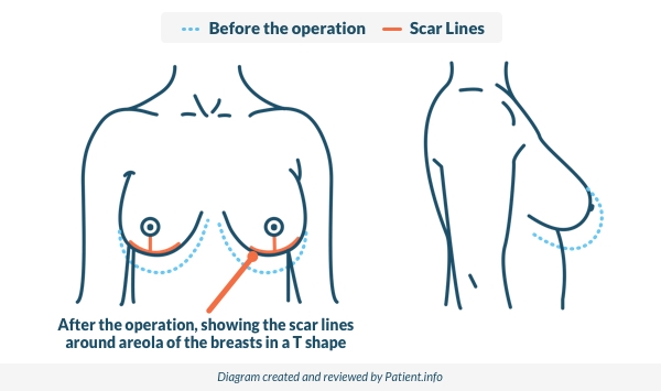 Breast reduction new