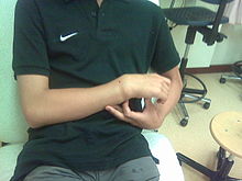 Colles fracture externally. Not an X-ray