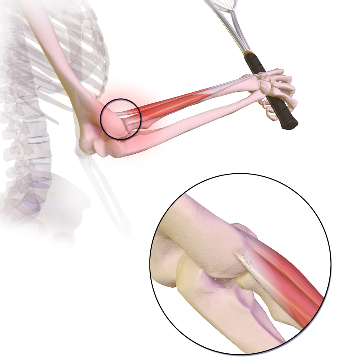drawing of tennis elbow
