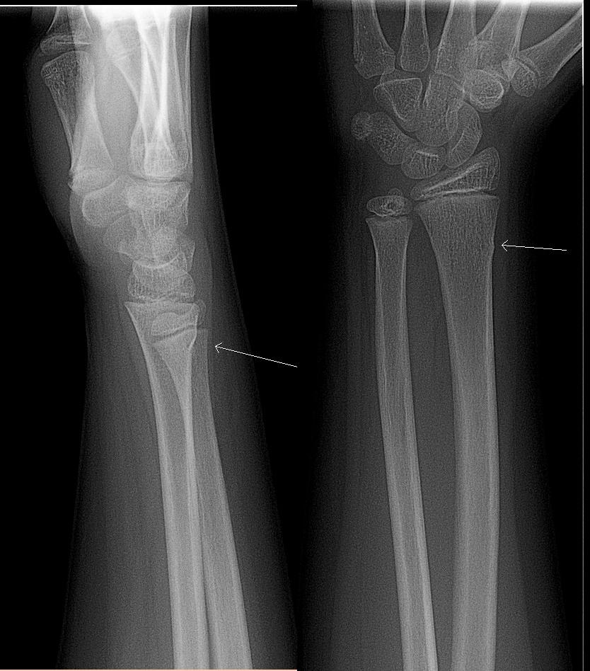 greenstick X-ray