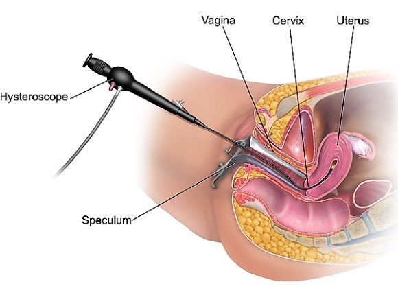 Hysteroscopy