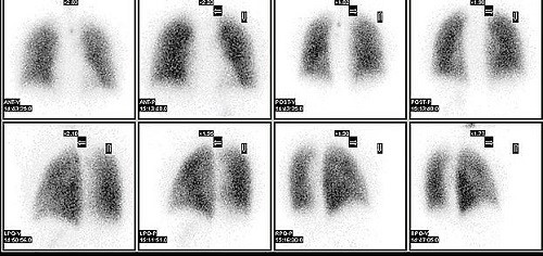 Lung perfusion scan