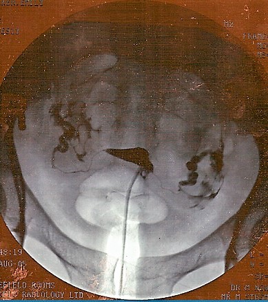 Hysterosalpingogram