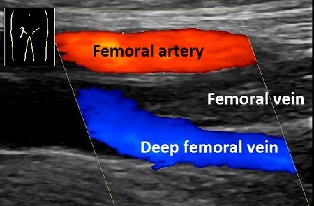 Colour ultrasonography
