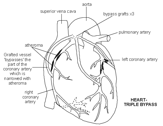 Triple heart bypass