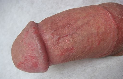 Close-up of an inflamed head of the penis, caused by balanitis.