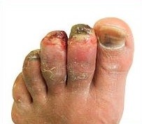 Frostbite - initial injury