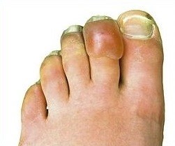 Frostbite injury post three weeks