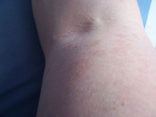 Pityriasis versicolor close-up