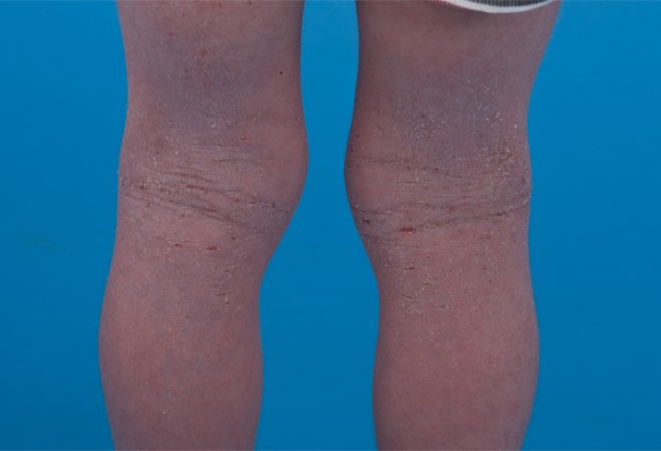 Atopic eczema