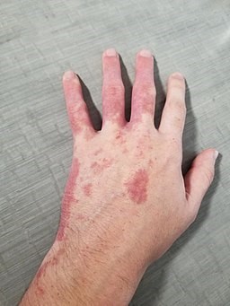Port-wine stain hand