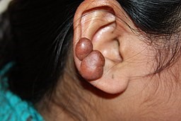 Keloid on ear