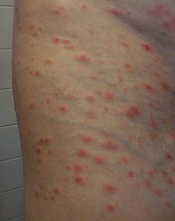 Pityriasis lichenoides et varioliformis acuta