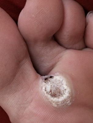 Sole of foot verruca