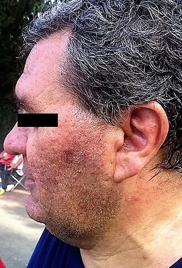 Rosacea in an adult male