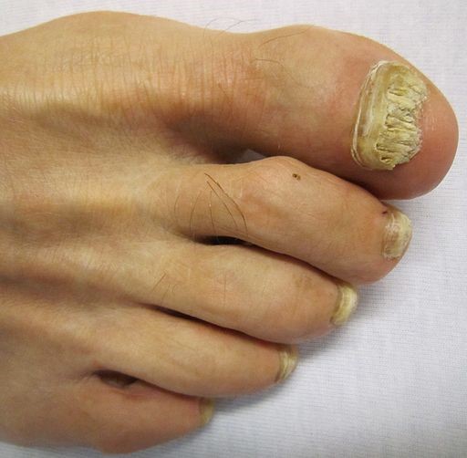 Toe onychomycosis