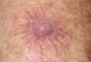 Squamous cell carcinoma