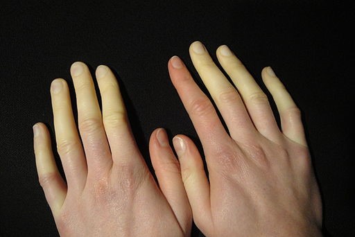 Raynaud's disease
