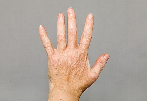 Vitiligo on left hand