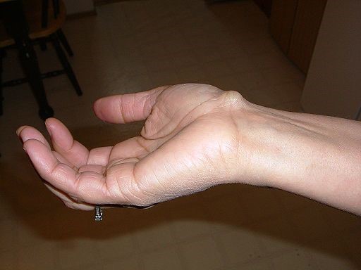 ganglion cyst wrist​

