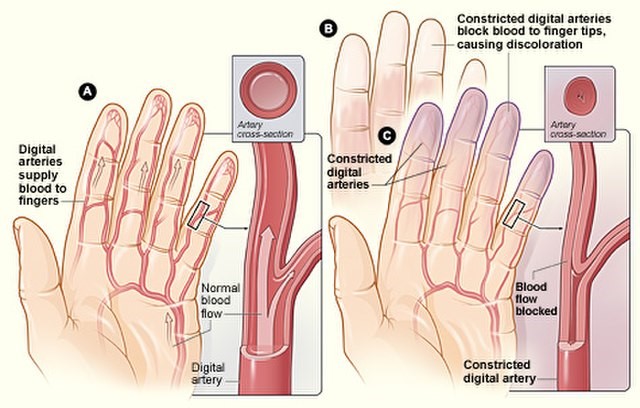 Raynaud s Phenomenon Raynaud s Syndrome