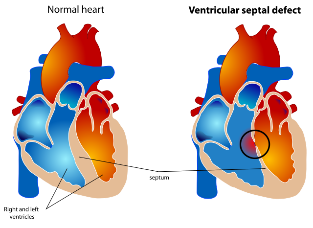 Ventricular septal defect