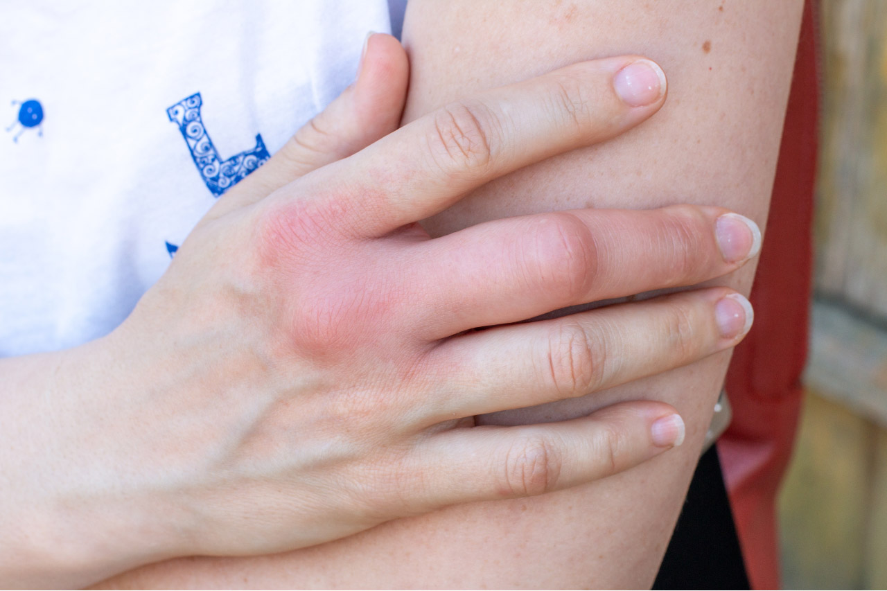 Photo of a wasp sting on a hand