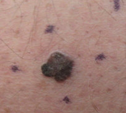 Malignant melanoma