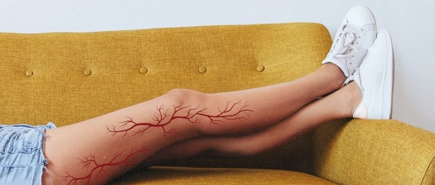 How to prevent varicose veins