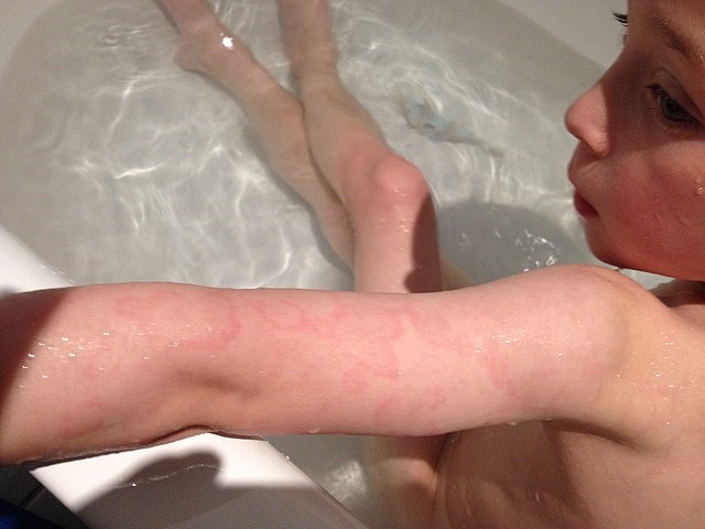 Erythema marginatum