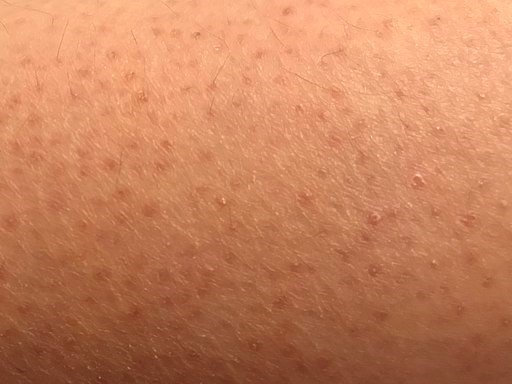Keratosis pilaris