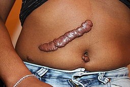 Keloid post-surgery