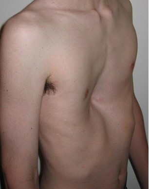 Pectus excavatum