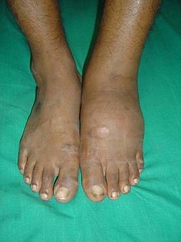 Charcot presentation