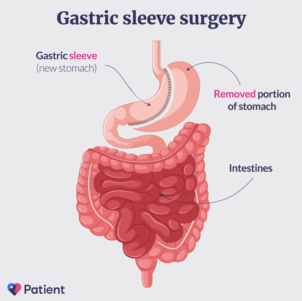 Gastric sleeve surgery