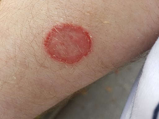 Ringworm (tinea corporis)