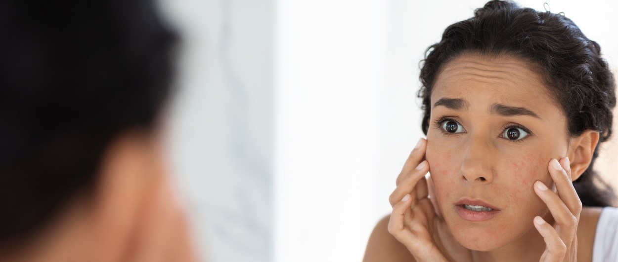 Why is my facial eczema worse in summer?