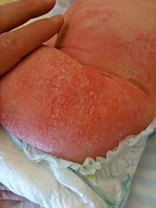 Atopic dermatitis child
